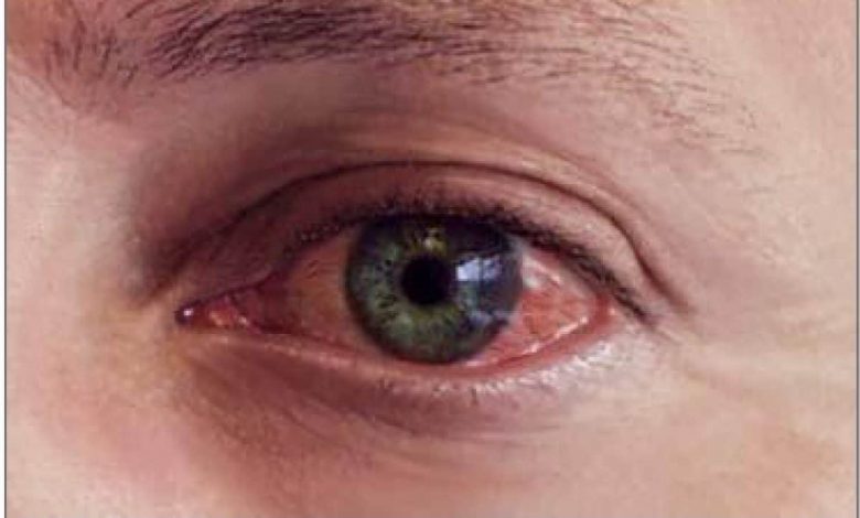 Ochii înroșiți semn de infecție cu virus
